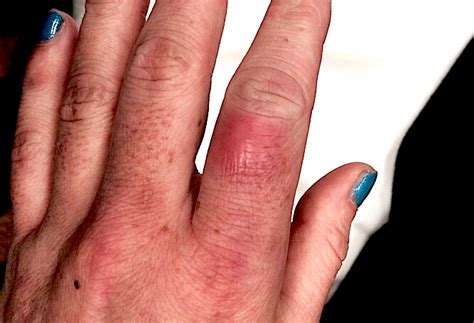 cellulitis icd 10|icd 10 cellulitis right hand.